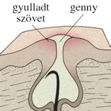 Pattanásos bőr