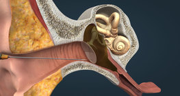 Middle ear infection, otitis media