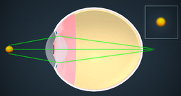 Vision correction