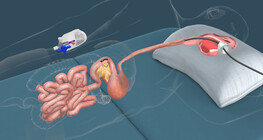 ERCP examination