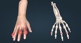 Gout
